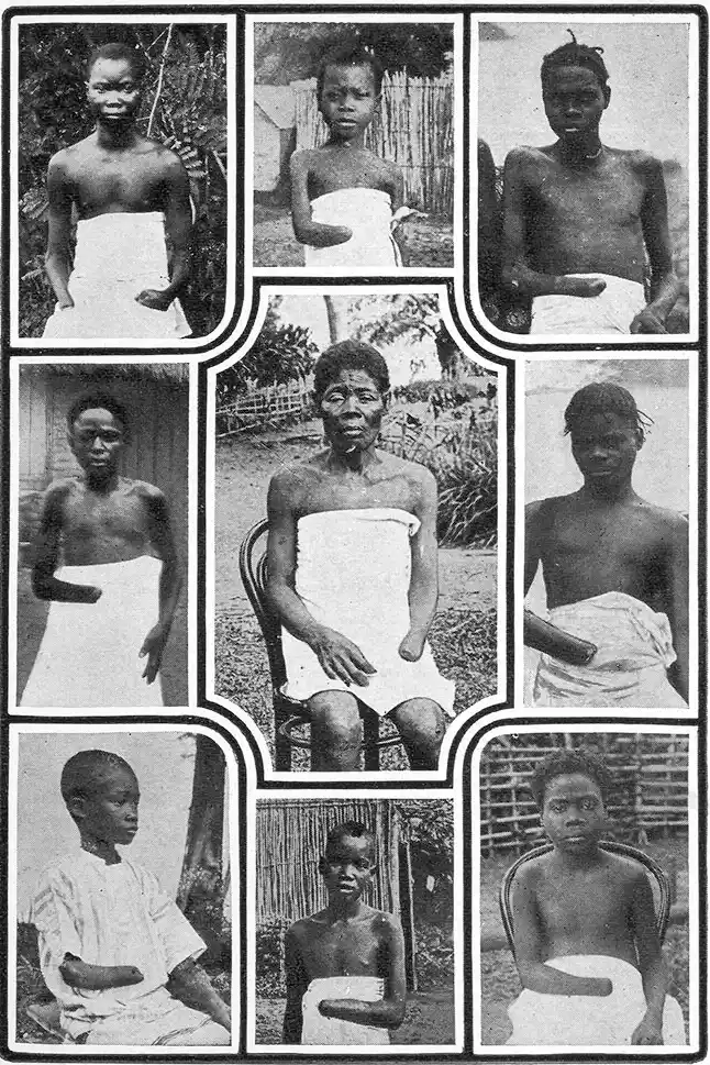 Mutilated Children From Congo.
